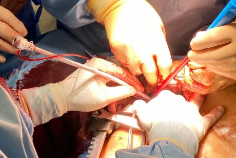 Lekarze z kieleckiego szpitala na Czarnowie wykonali innowacyjny zabieg
